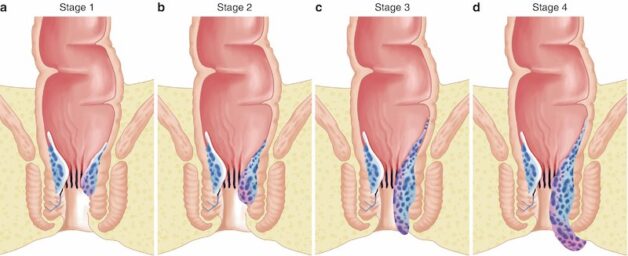 Góc giải đáp: Bệnh trĩ có đau lưng không?