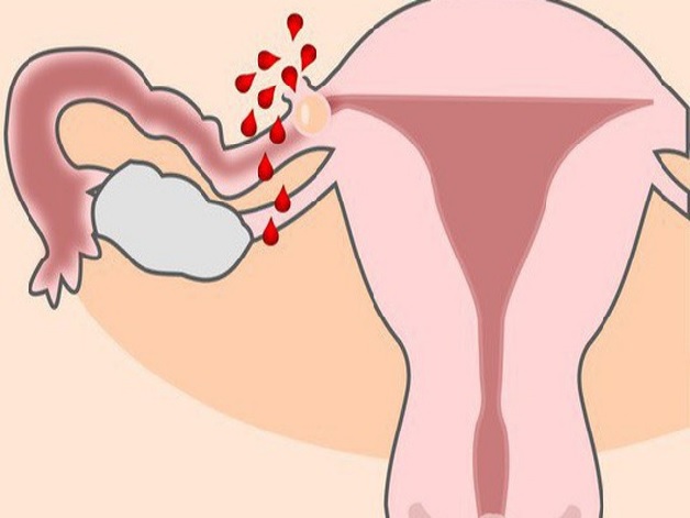 Góc giải đáp: Chửa ngoài dạ con có những biểu hiện gì?