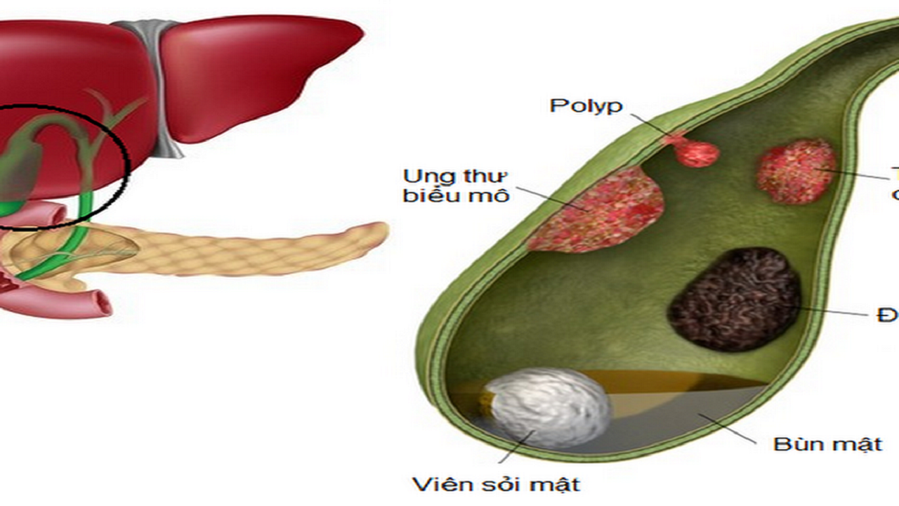 Góc giải đáp Polyp túi mật là gì và có cần điều trị không?