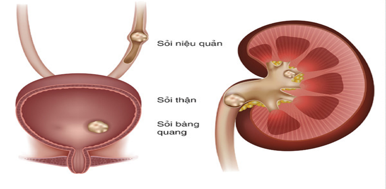 Góc giải đáp: sỏi niệu quản bao nhiêu thì phải mổ