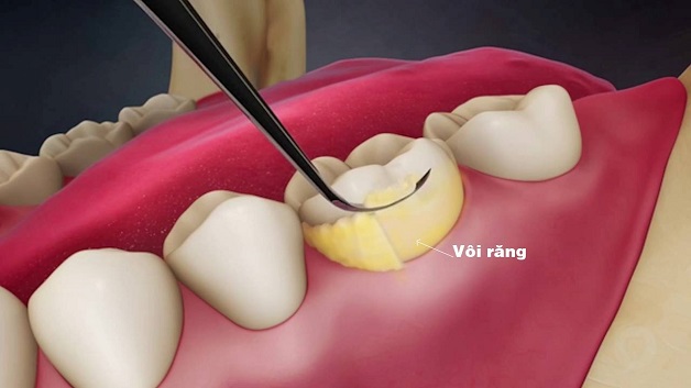 Góc giải đáp: “Sưng nướu răng làm sao hết?” 