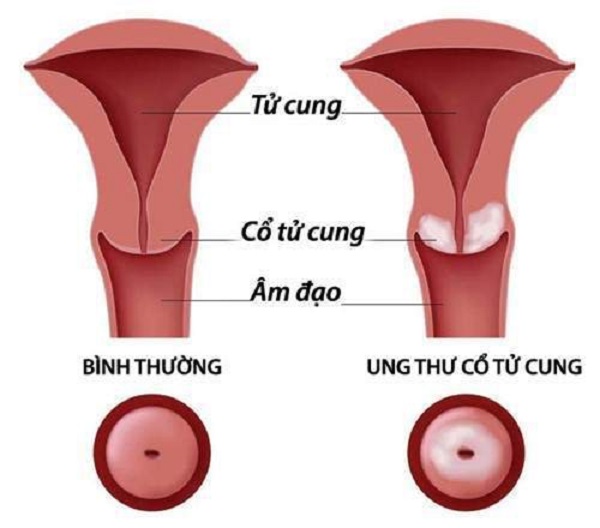 Gói khám tầm soát ung thư cổ tử cung hết bao nhiêu tiền?