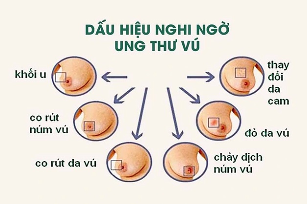 Gói tầm soát ung thư vú của Hệ thống Y tế Thu Cúc TCI