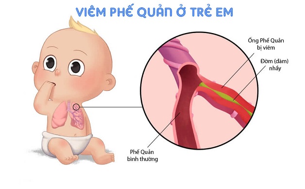 Gợi ý bố mẹ lập kế hoạch chăm sóc bệnh nhi viêm phế quản