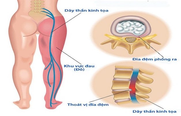 Gợi ý một số cách xoa bóp chữa đau thần kinh tọa