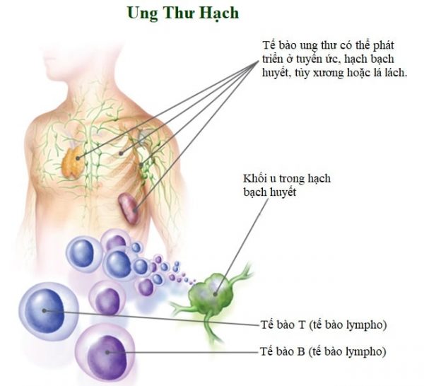 Hạch bạch huyết là gì? Khi nào thì gây ung thư?