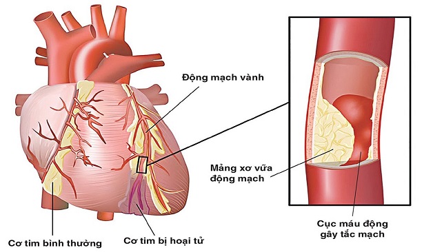 Hàng loạt biến chứng “khủng khiếp” từ bệnh đái tháo đường