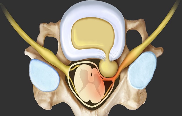 Hậu quả của thoát vị đĩa đệm chèn dây thần kinh