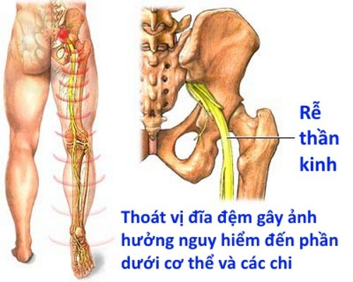 Hậu quả của thoát vị đĩa đệm người bệnh nếu không phát hiện