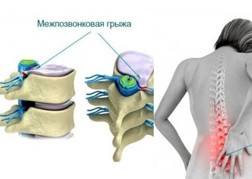 Hậu quả của thoát vị đĩa đệm người bệnh nếu không phát hiện