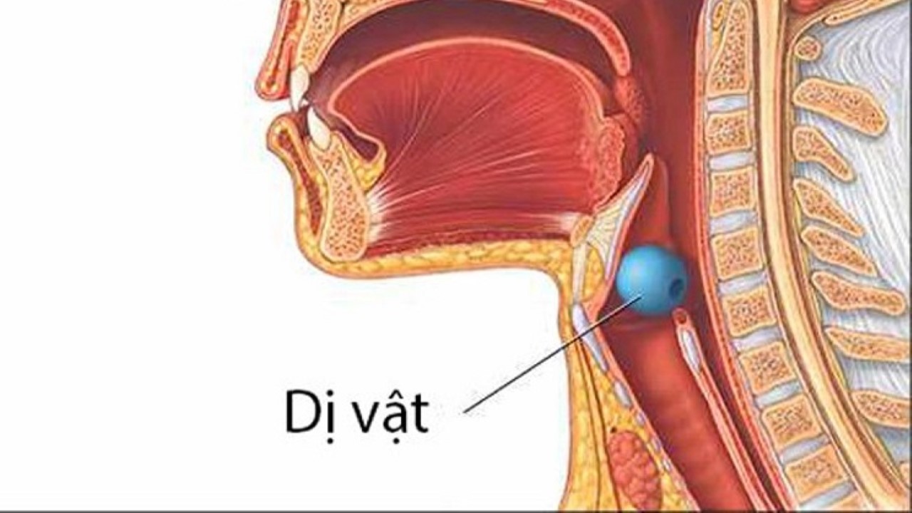 Hậu quả khi không kịp thời xử lý hóc dị vật đường thở ở trẻ