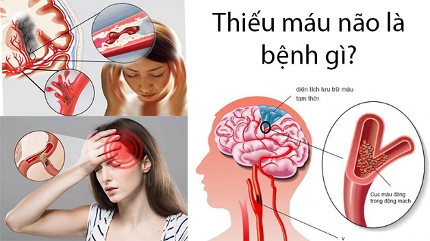 Hay bị đau nửa đầu coi chừng một số bệnh lý trong não