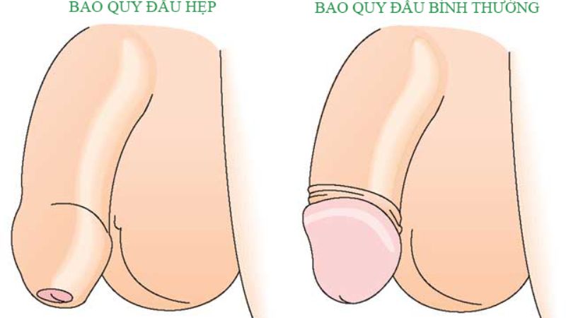 Hẹp bao quy đầu ở người lớn và nguy cơ ung thư dương vật