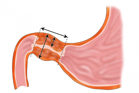 Hẹp phì đại môn vị bẩm sinh