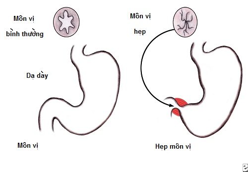 Hẹp phì đại môn vị bẩm sinh