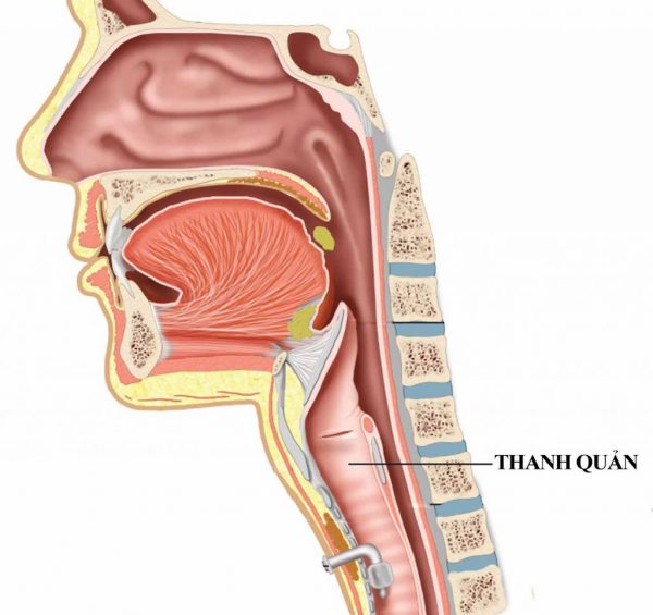 Hẹp thanh quản: Nguyên nhân và triệu chứng