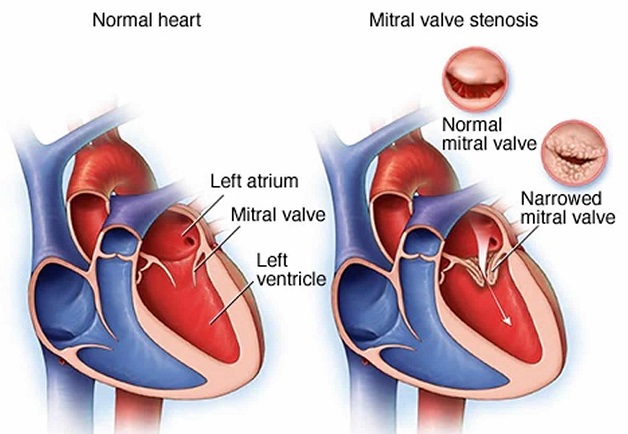 Hẹp van 2 lá: Nguyên lý, triệu chứng và cách điều trị