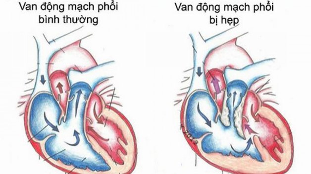 Hẹp van động mạch phổi là gì và có nguy hiểm không?