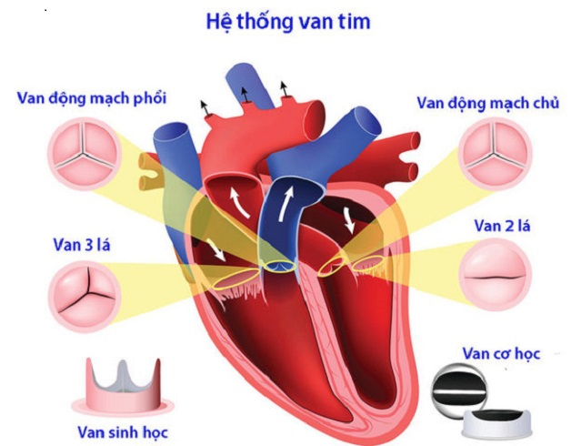 Hẹp van động mạch phổi: Triệu chứng và biến chứng