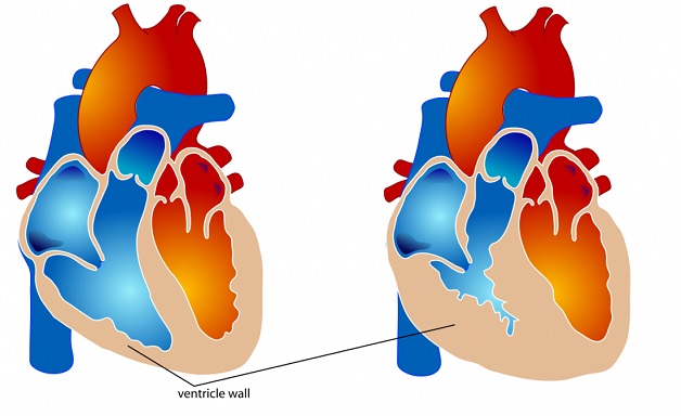 Hẹp van động mạch phổi: Triệu chứng và biến chứng