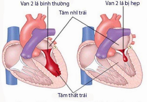 Hẹp van tim 2 lá: Nguyên nhân, triệu chứng và cách điều trị