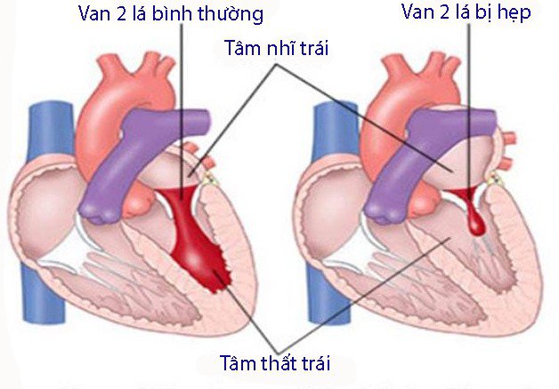 Hẹp van tim hai lá là gì? Triệu chứng và cách điều trị