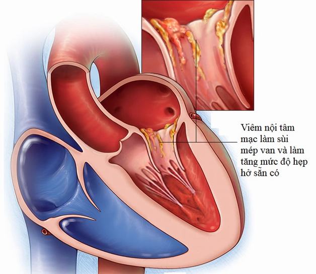 Hẹp van tim là sao? Nguyên nhân, triệu chứng và cách điều trị