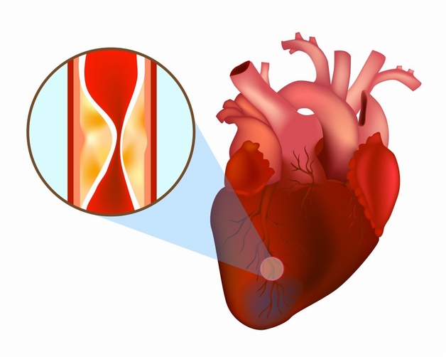 Hiểm họa tiềm ẩn từ co thắt mạch vành tim