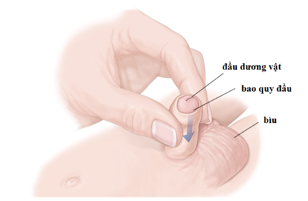 Hiện tượng hẹp bao quy đầu ở trẻ em: Nguyên nhân, cách điều trị?