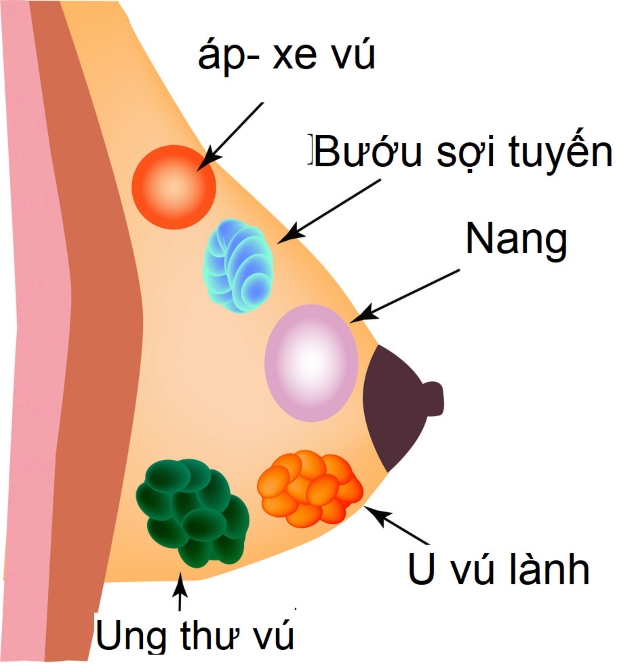 Hiện tượng tắc tia sữa gây áp xe cần phải điều trị ra sao?