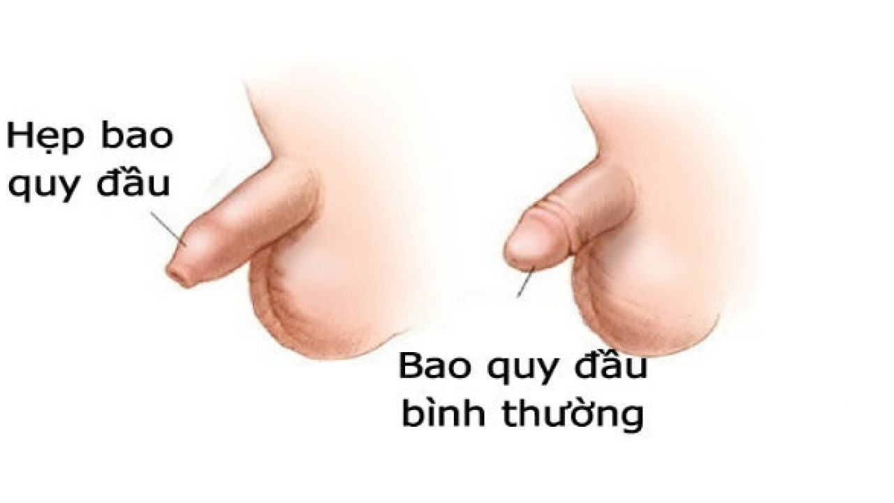 Hiện tượng trẻ hẹp bao quy đầu có nguy hiểm không?