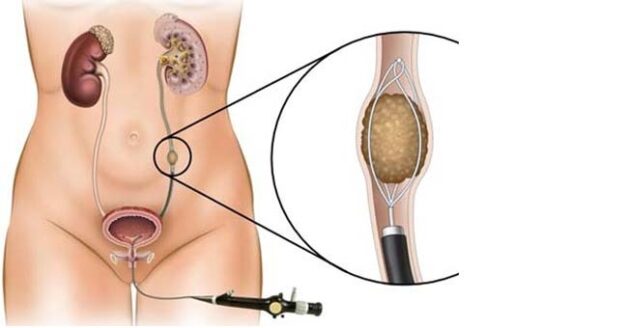 Hiểu biết về nội soi ngược dòng trong điều trị sỏi niệu quản