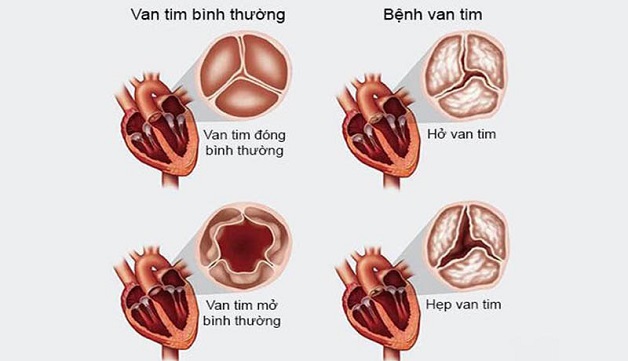 Hiểu ngọn ngành về căn bệnh hẹp van tim