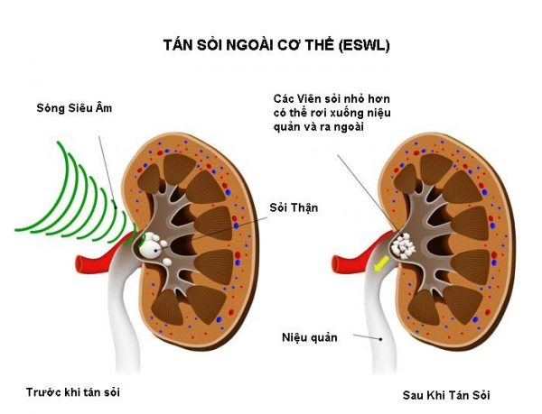 Hiệu quả tán sỏi ngoài cơ thể phụ thuộc vào yếu tố nào?