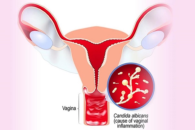 Hiểu rõ nguyên nhân gây nấm âm đạo và cách phòng tránh