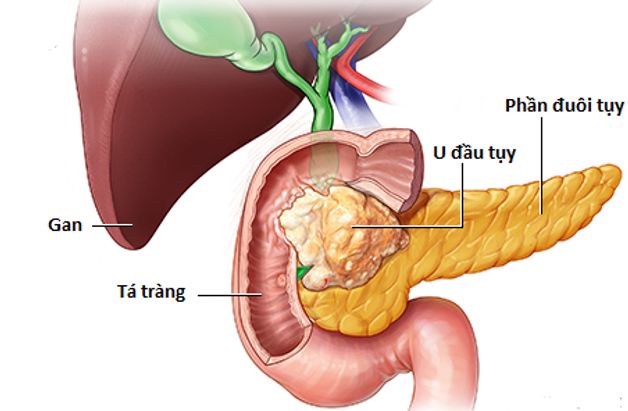 Hiểu rõ triệu chứng ung thư tụy ngoại tiết