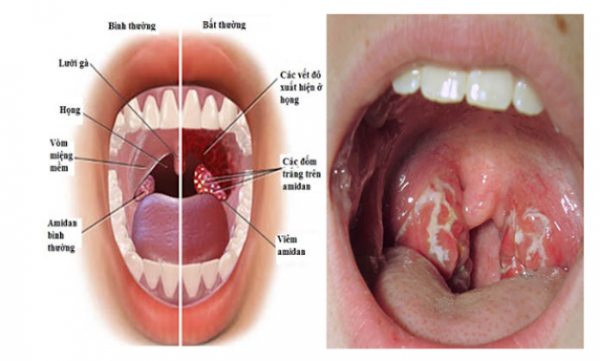 Hiểu rõ về bệnh viêm amidan để tránh gặp biến chứng