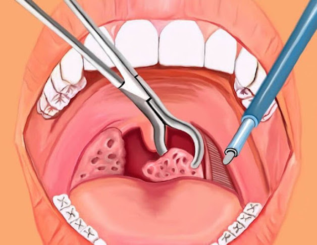 Hiểu rõ về bệnh viêm amidan để tránh gặp biến chứng