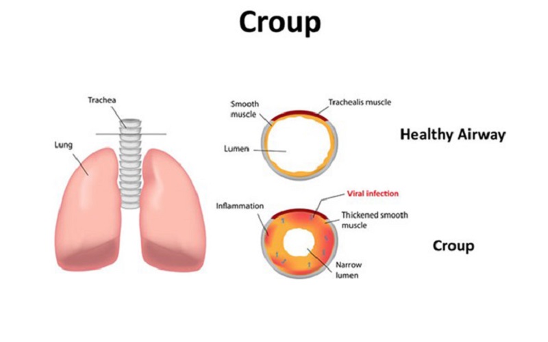 Hiểu rõ về bệnh viêm thanh khí phế quản cấp ở trẻ