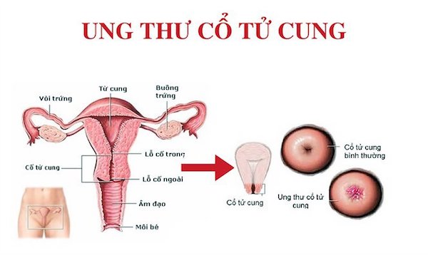 Hiểu rõ về quy trình tầm soát ung thư cổ tử cung