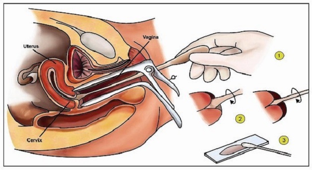 Hiểu rõ về xét nghiệm tầm soát ung thư cổ tử cung HPV