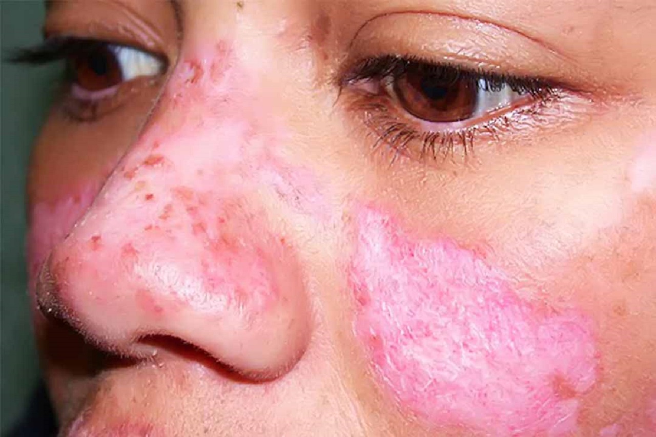 Hiểu về bệnh lupus ban đỏ cách điều trị đúng cách