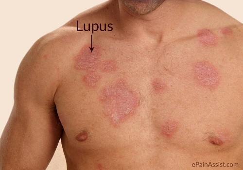 Hiểu về bệnh lupus ban đỏ cách điều trị đúng cách