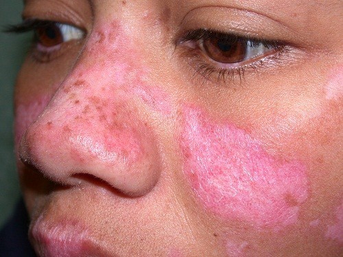 Hiểu về bệnh lupus ban đỏ cách điều trị đúng cách