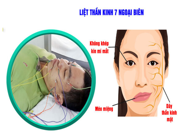 Hiểu về liệt dây thần kinh số 7 ngoại biên (liệt mặt)