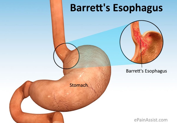 Hình ảnh Barrett thực quản