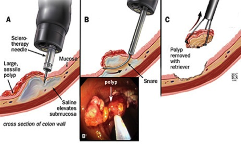 Hình ảnh bệnh polyp đại trực tràng