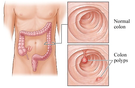 Hình ảnh bệnh polyp đại trực tràng