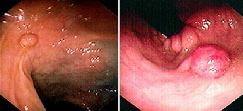 Hình ảnh bệnh polyp đại trực tràng