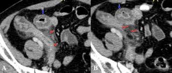 Hình ảnh CT viêm ruột thừa